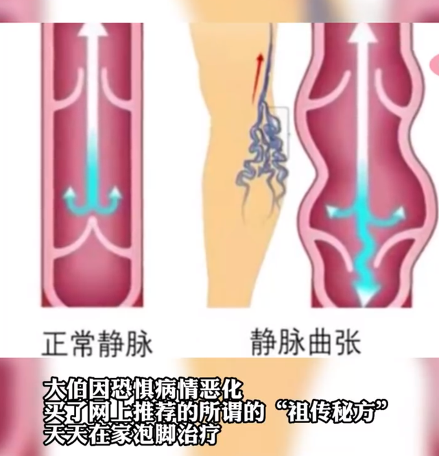 深藏小巷的静脉秘诀，揭秘最新静脉曲张治疗方案，十一月最新治疗策略